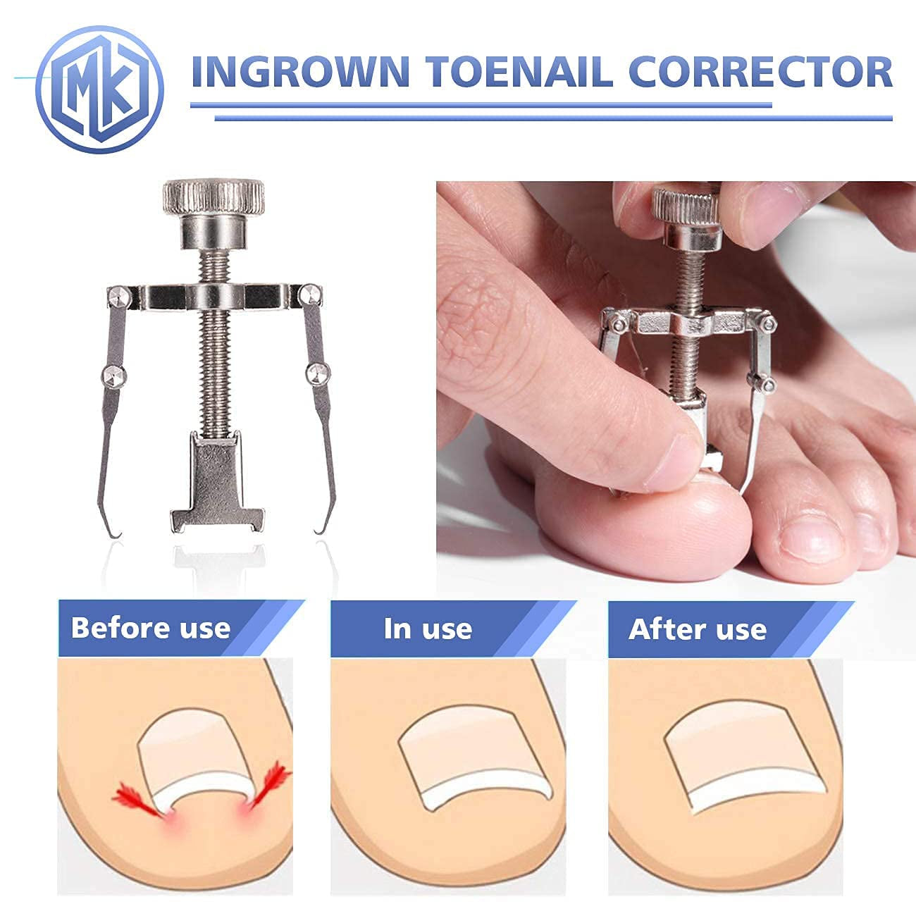 Toenail Clippers Kit for Ingrown/Thick Nail, Ingrown Toenail Tool Kit with Ingrown Toenail Clipper/Corrector, Wide Jaw Opening Nail Clipper for Thick Nail, Pedicure Tool for Seniors/Adult by MAYKI Health & Beauty > Personal Care > Cosmetics > Cosmetic Tools > Nail Tools MAYKI