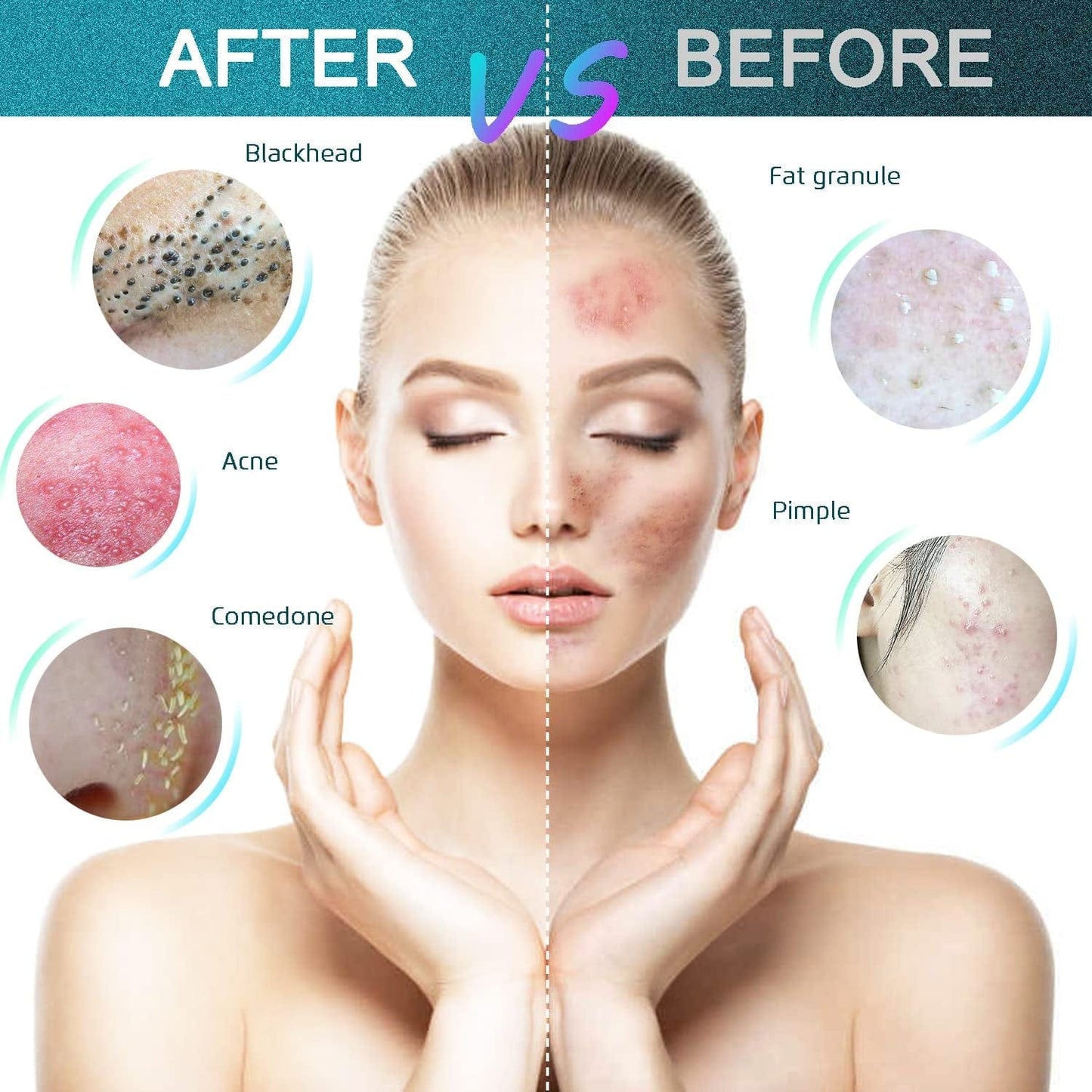 22PCS Blackhead Remover Tools, Acne Blemish Removal, Pimple Popper Extractor, Comedone Whitehead Zit Tweezers, Stainless Steel with Metal Case Health & Beauty > Personal Care > Cosmetics > Cosmetic Tools > Skin Care Tools THEDEFOL