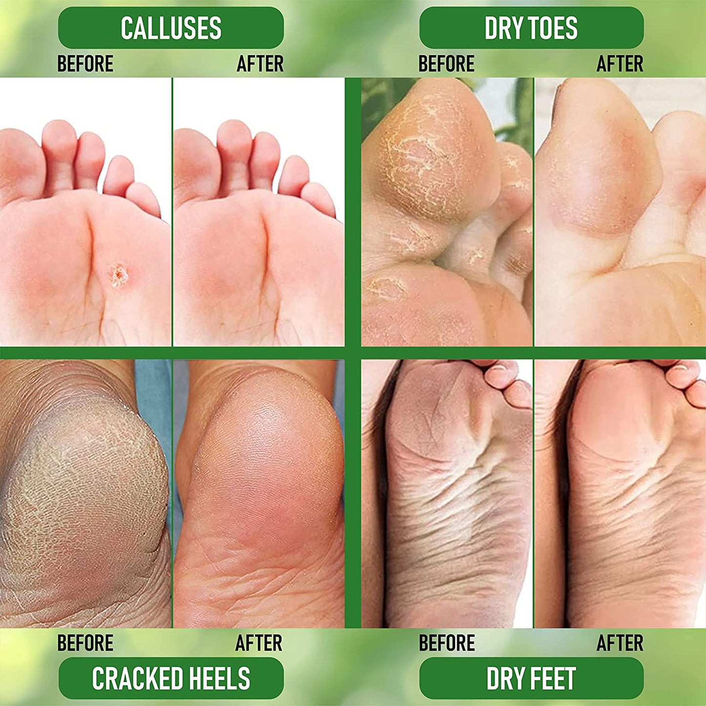 Purorganica Urea 40% Foot Cream - No Pumice Stone - Callus Remover - Moisturizes & Rehydrates Thick, Cracked, Rough, Dead & Dry Skin - for Feet, Elbows and Hands - Made in USA Health & Beauty > Personal Care > Foot Care PurOrganica