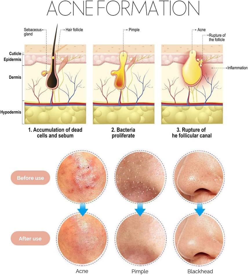 7 in 1 Pimple Blackhead Remover Extractor Tool Kit, Teenitor Professional Safe Treatment for Zit Popper White Head Acne Blemish Comedone Removing for Nose Face Skin Health & Beauty > Personal Care > Cosmetics > Cosmetic Tools > Skin Care Tools Teenitor