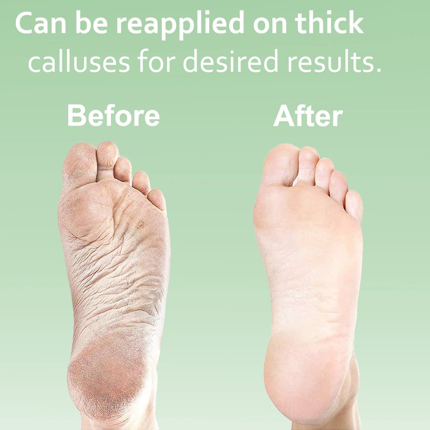 Dr. Entre'S Callus Remover Kit for Feet: 8Oz Callus Remover Gel, Foot File, Pumice Stone, 5 Glove Pairs for Gel Application, Spa Kit, Foot Care, Pedicure Tools, Scrubber Health & Beauty > Personal Care > Foot Care EntreFeet