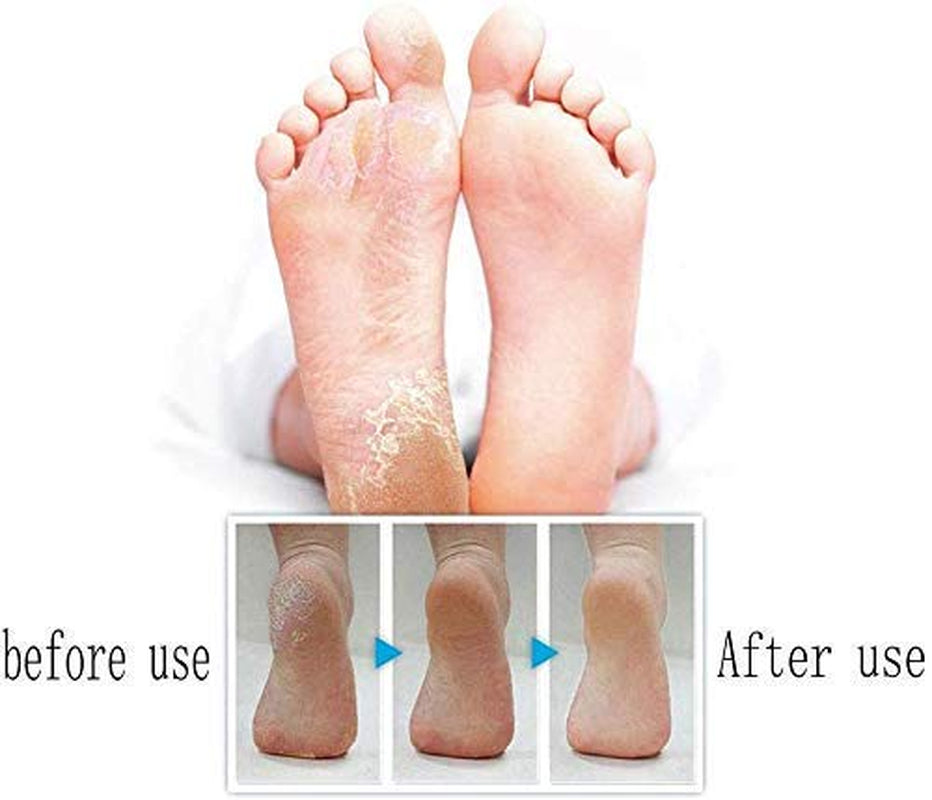 Foot Care Pedicure Callus Shaver Hard Skin Remover,Hand Callus Remover,Foot Callus Shaver Heel Hard Skin Remover for Hand Feet with Stainless Steel Handle(24Pieces) Health & Beauty > Personal Care > Foot Care Klemon