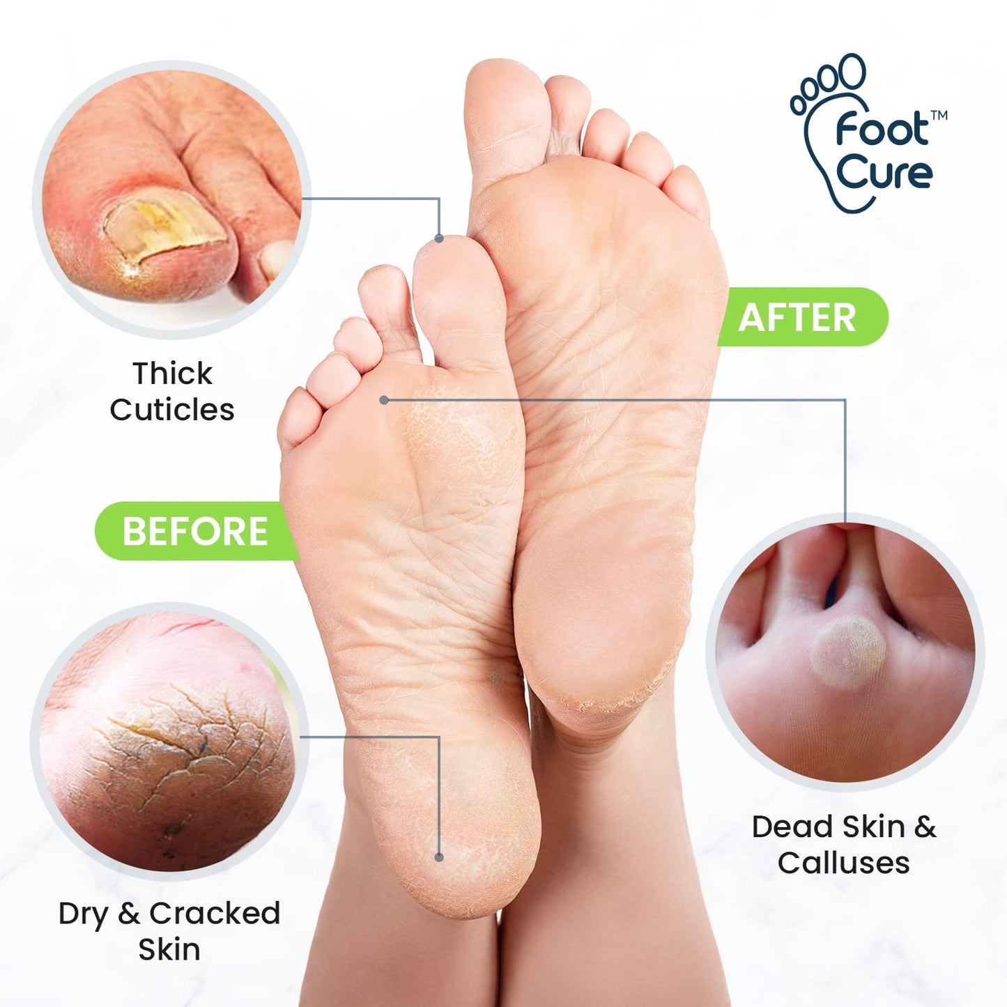 Tea Tree Foot Soak & Callus Remover Gel Kit - Extra Strength Callus Remover Gel & Antifungal Foot Soak with Epsom Salts for Calluses, Dry Cracked Heels, Toenail Fungus & Odor - Pedicure for Tired Feet Health & Beauty > Personal Care > Foot Care FOOT CURE