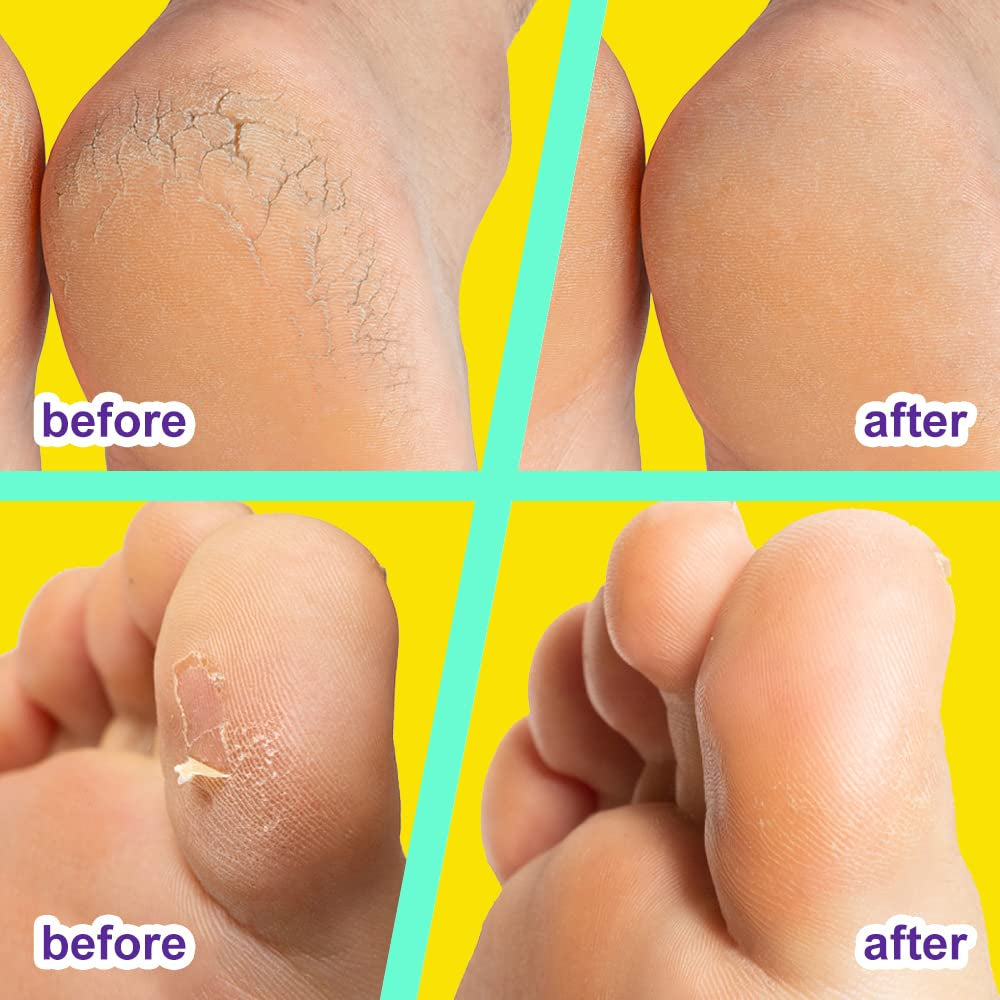 Urea Cream 42% for Feet, 4 Oz-A Complete Callus-Care, Designed to a Complete Foot Cream & Specially Designed for Dry & Cracked Feet, Hands, Heels, Elbows, Nails, Knees, Strengthens and Softens Skin Health & Beauty > Personal Care > Foot Care ENVISHA