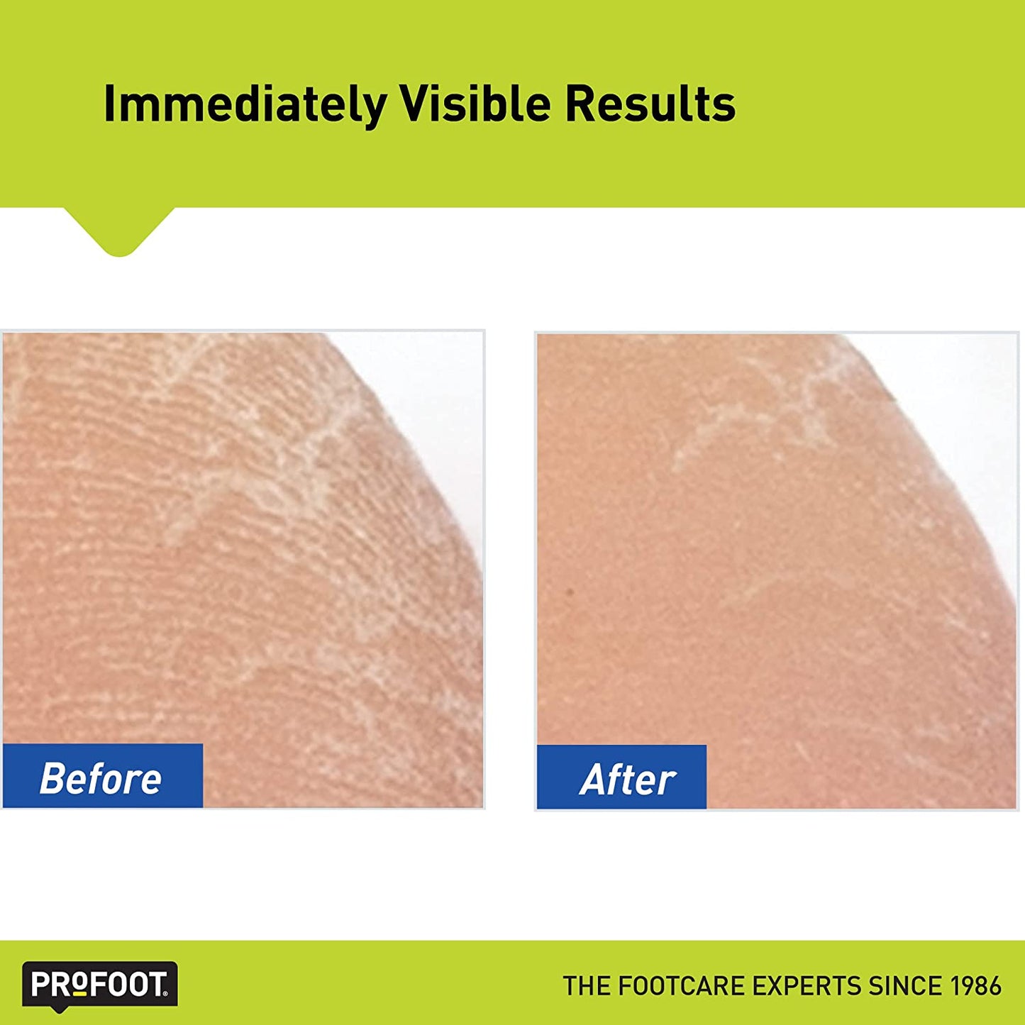 Profoot Heel Rescue Foot Cream 16 Ounce Bottle, 2 Pack, for Cracked, Calloused, or Chapped Skin Health & Beauty > Personal Care > Foot Care Profoot