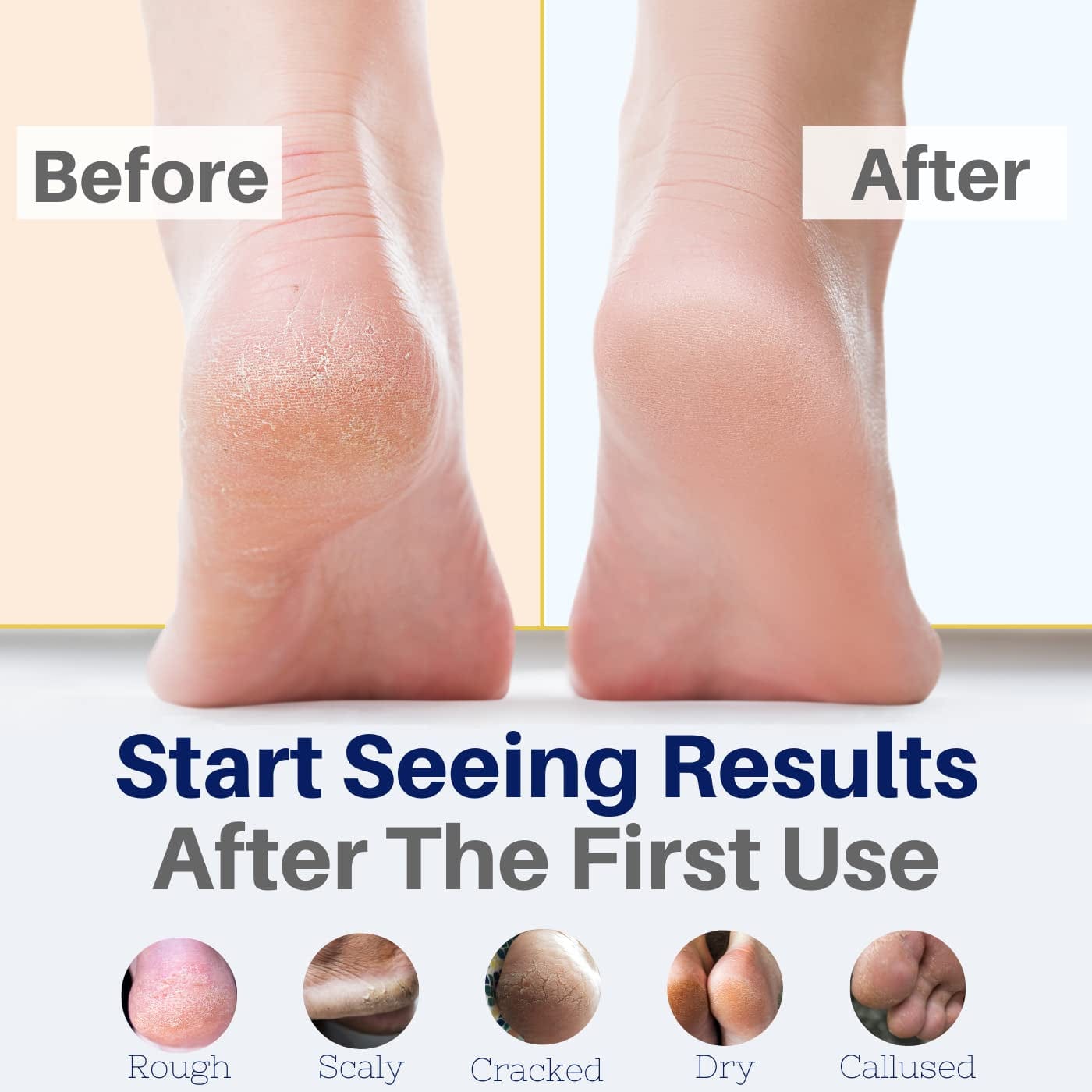 Yellow Bird Natural Foot Cream - Dry Feet Balm , Cracked Heel Moisturizer, Organic Athletes Foot Repair Salve with Tea Tree Oil & Peppermint. Moisturizing Callus Care, Toenail Treatment Creme Health & Beauty > Personal Care > Foot Care The Yellow Bird