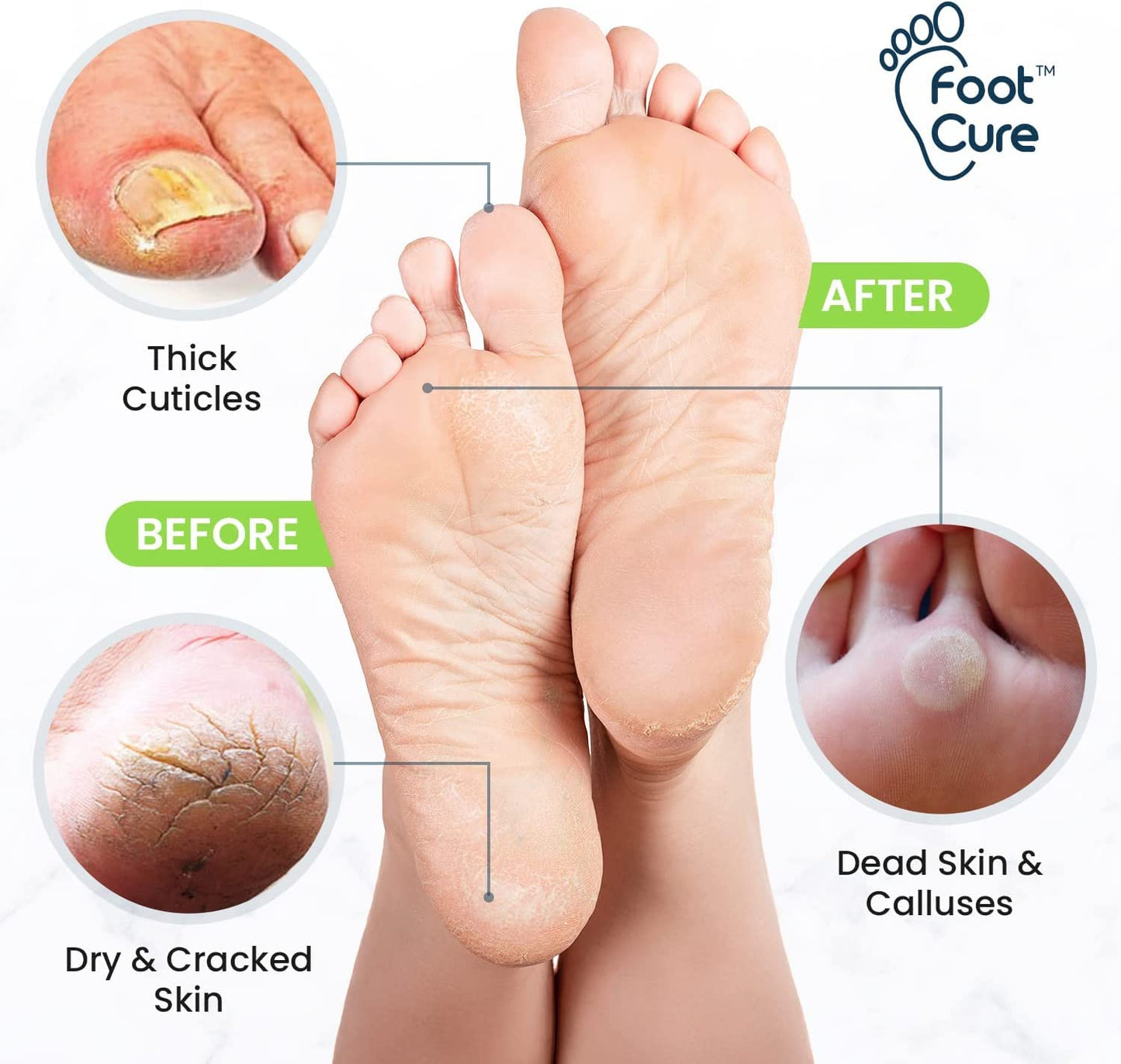 Tea Tree Foot Soak, Callus Remover Gel & Foot File Kit - Extra Strength Callus Remover Gel & Foot Soak with Epsom Salts for Calluses, Dry Cracked Heels, Toenail Fungus & Odor - Pedicure for Tired Feet Health & Beauty > Personal Care > Foot Care FOOT CURE   