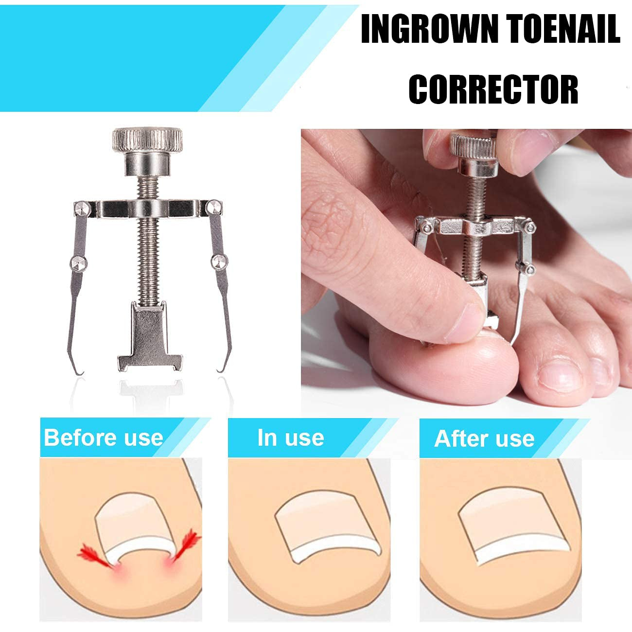 Ingrown Toenail Tool Kit (9PCS), Professional Toe Nail Clipper Set for Ingrown & Thick Nail, Stainless Steel Ingrown Toenail Kit, Surgery Grade Manicure Pedicure Tool by Dualeco Health & Beauty > Personal Care > Cosmetics > Cosmetic Tools > Nail Tools Dualeco   