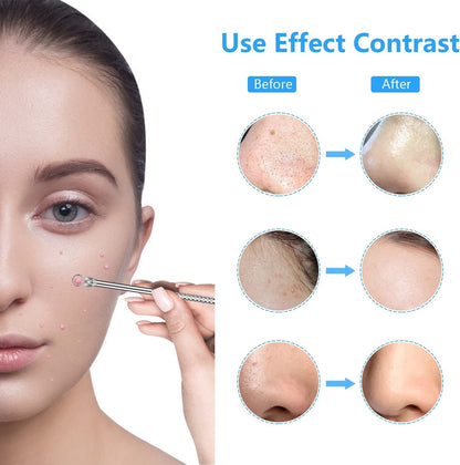 2022 Latest Blackhead Remover Pimple Popper Tool Kit, 20PCS Black Head Extractions Tool, Comedone Extractor Acne Blackhead Extractor Tool Kits Acne Removal Kit for Pimple Acne Blackhead Whitehead Health & Beauty > Personal Care > Cosmetics > Cosmetic Tools > Skin Care Tools KEEPUON   