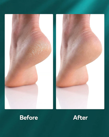 MR.GREEN Foot Rasp Foot File and Callus Remover Foot Care Pedicure Metal Surface Tool to Remove Hard Skin, Surgical Grade Stainless Steel File (Black) Health & Beauty > Personal Care > Foot Care MR.GREEN   