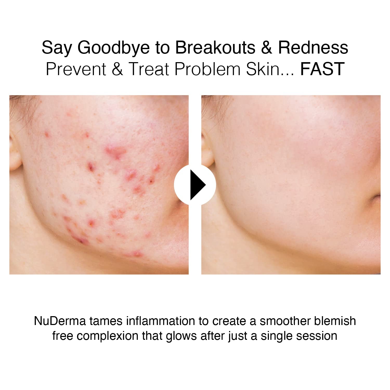 Nuderma Portable Handheld High Frequency Skin Therapy Wand Machine W/Neon – Anti-Aging - Skin Tightening - Wrinkle Reducing - Dark Circles – Blemish Control - Hair & Scalp Stimulator Health & Beauty > Personal Care > Cosmetics > Cosmetic Tools > Skin Care Tools Pure Daily Care   