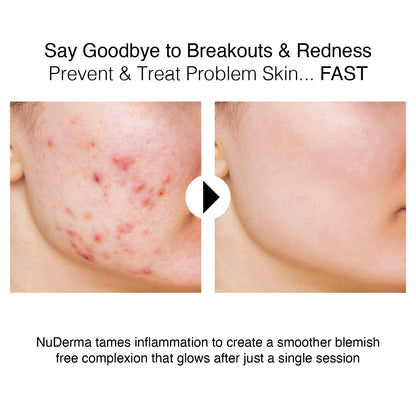 Nuderma Portable Handheld High Frequency Skin Therapy Wand Machine W/Neon – Anti-Aging - Skin Tightening - Wrinkle Reducing - Dark Circles – Blemish Control - Hair & Scalp Stimulator Health & Beauty > Personal Care > Cosmetics > Cosmetic Tools > Skin Care Tools Pure Daily Care   