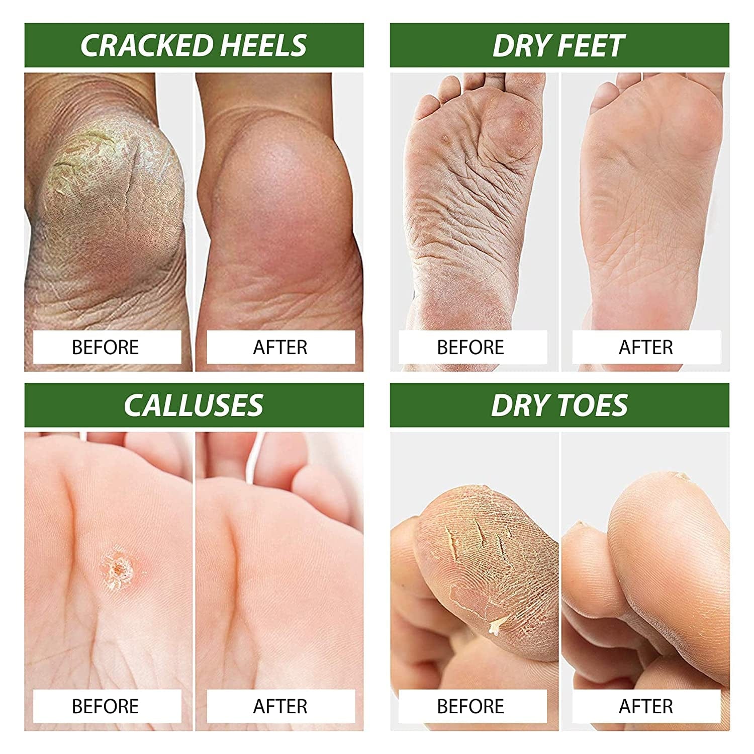 4 in 1 Tea Tree Oil Foot Soak, Super Balm, Nail Repair Oil and Body Wash Set - for Damaged Nails, Itchy Skin, Athletes Foot, Smelly Feet, Cracked Heels and Calluses - Made in the USA Health & Beauty > Personal Care > Foot Care DAILY REMEDY   