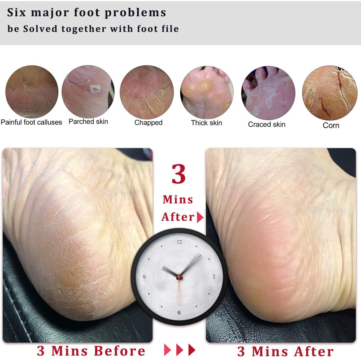 Kinepi Foot Scrubber Pedicure Foot File Pumice Stone,Professional Pedicure Supplies Callus Remove Cracked Heels,Dead Skin,Corn,Scraper File Foot Care Foot Rasp Massage Brush Tools Kit for Men/Women Health & Beauty > Personal Care > Foot Care Kinepi   