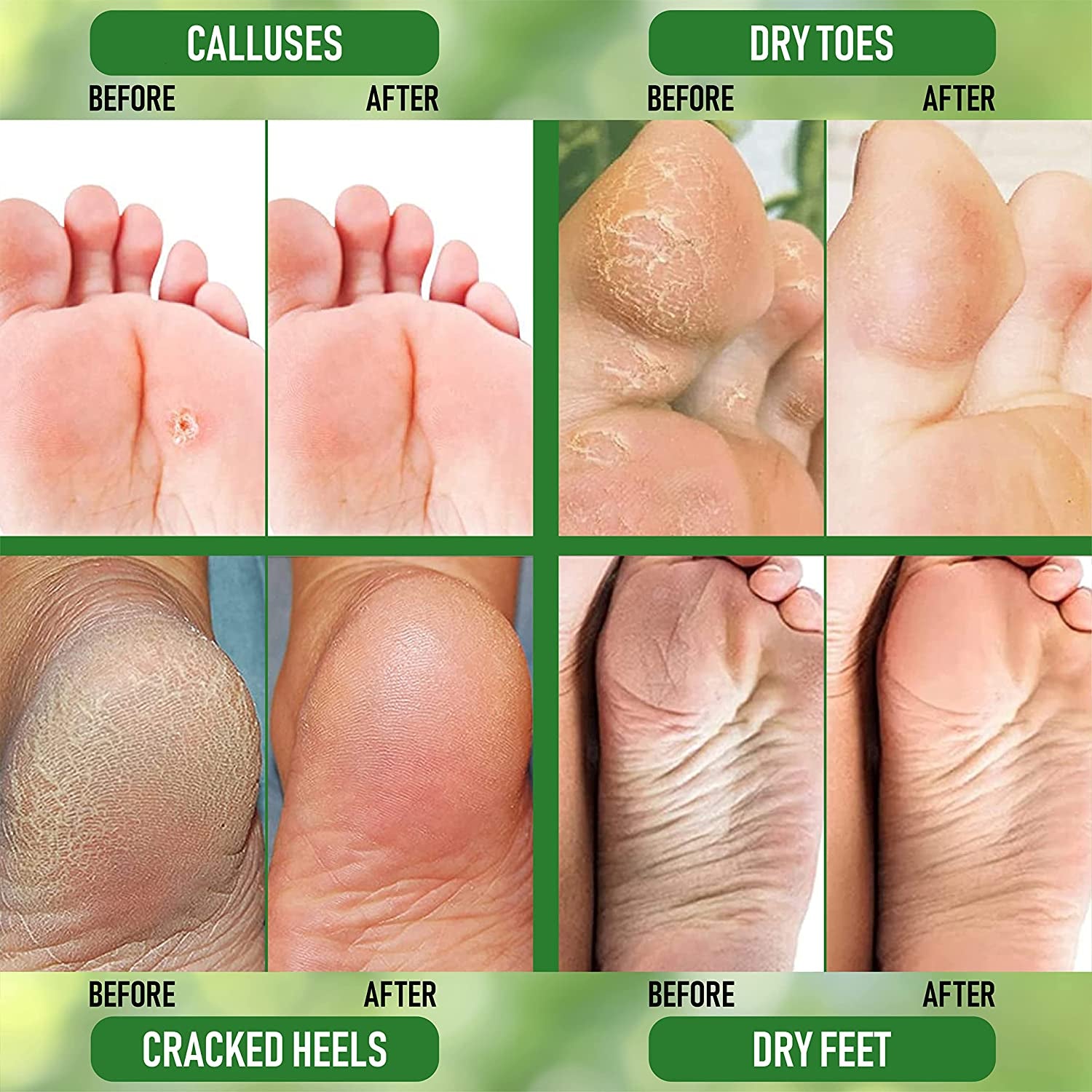 Purorganica Urea 40% Foot Cream - No Pumice Stone - Callus Remover - Moisturizes & Rehydrates Thick, Cracked, Rough, Dead & Dry Skin - for Feet, Elbows and Hands - Made in USA Health & Beauty > Personal Care > Foot Care PurOrganica   