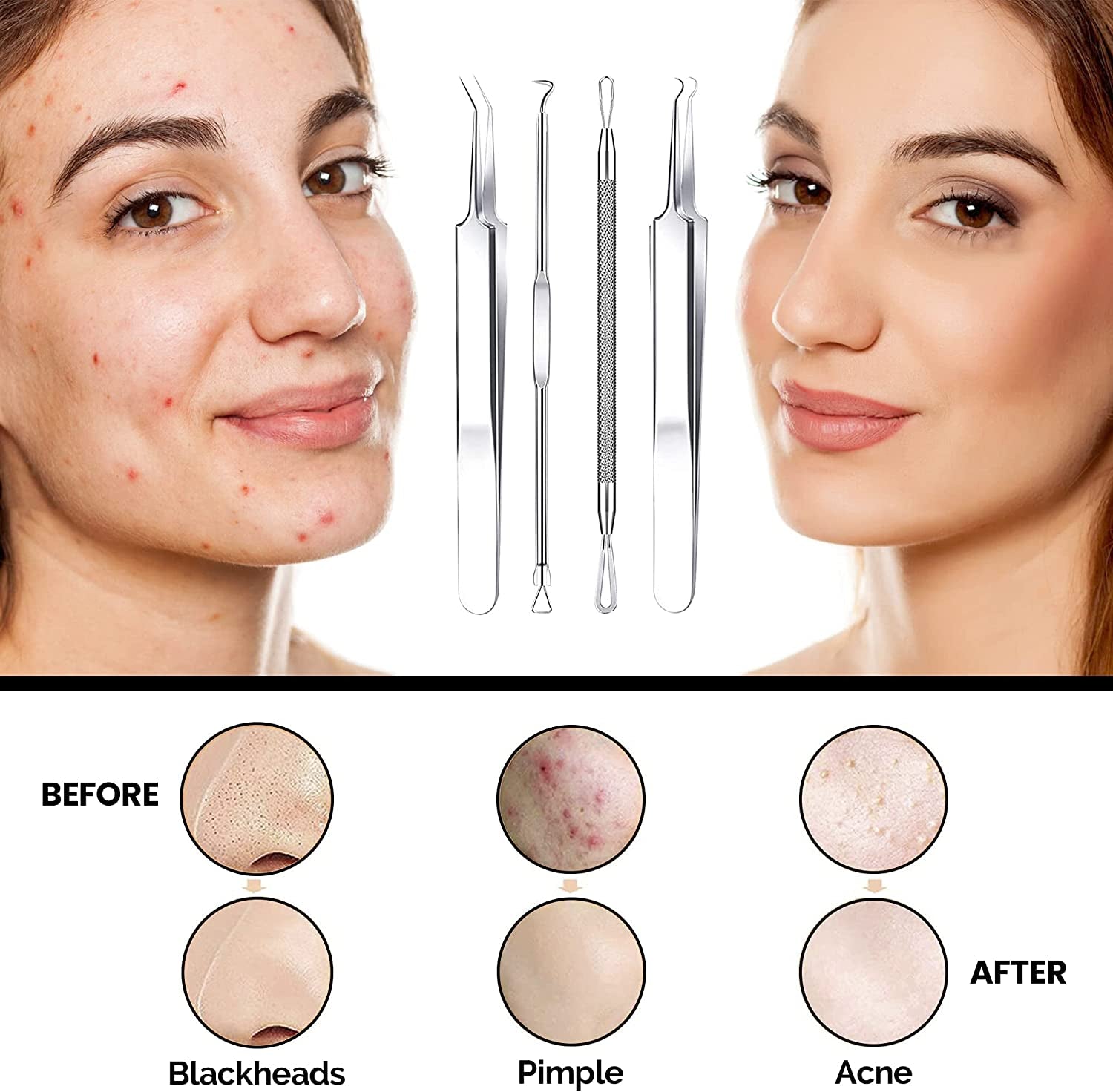Dermated [16 Pack] Blackhead Remover Tools Pimple Popper Tool Kit | Stainless Steel Professional Pimple Extractor Tool Kit for Blackheads, Blemish, Comdone, Acne, Zit, and Whiteheads for Face & Nose Health & Beauty > Personal Care > Cosmetics > Cosmetic Tools > Skin Care Tools DERMATED   