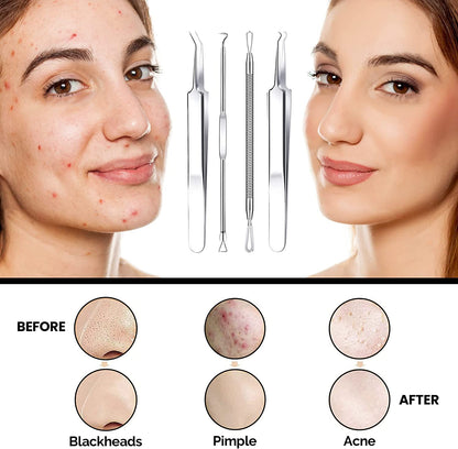 Dermated [16 Pack] Blackhead Remover Tools Pimple Popper Tool Kit | Stainless Steel Professional Pimple Extractor Tool Kit for Blackheads, Blemish, Comdone, Acne, Zit, and Whiteheads for Face & Nose Health & Beauty > Personal Care > Cosmetics > Cosmetic Tools > Skin Care Tools DERMATED   