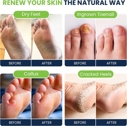 Tea Tree Foot Soak, Callus Remover Gel & Foot File Kit - Extra Strength Callus Remover Gel & Foot Soak with Epsom Salts for Calluses, Dry Cracked Heels, Toenail Fungus & Odor - Pedicure for Tired Feet Health & Beauty > Personal Care > Foot Care FOOT CURE   