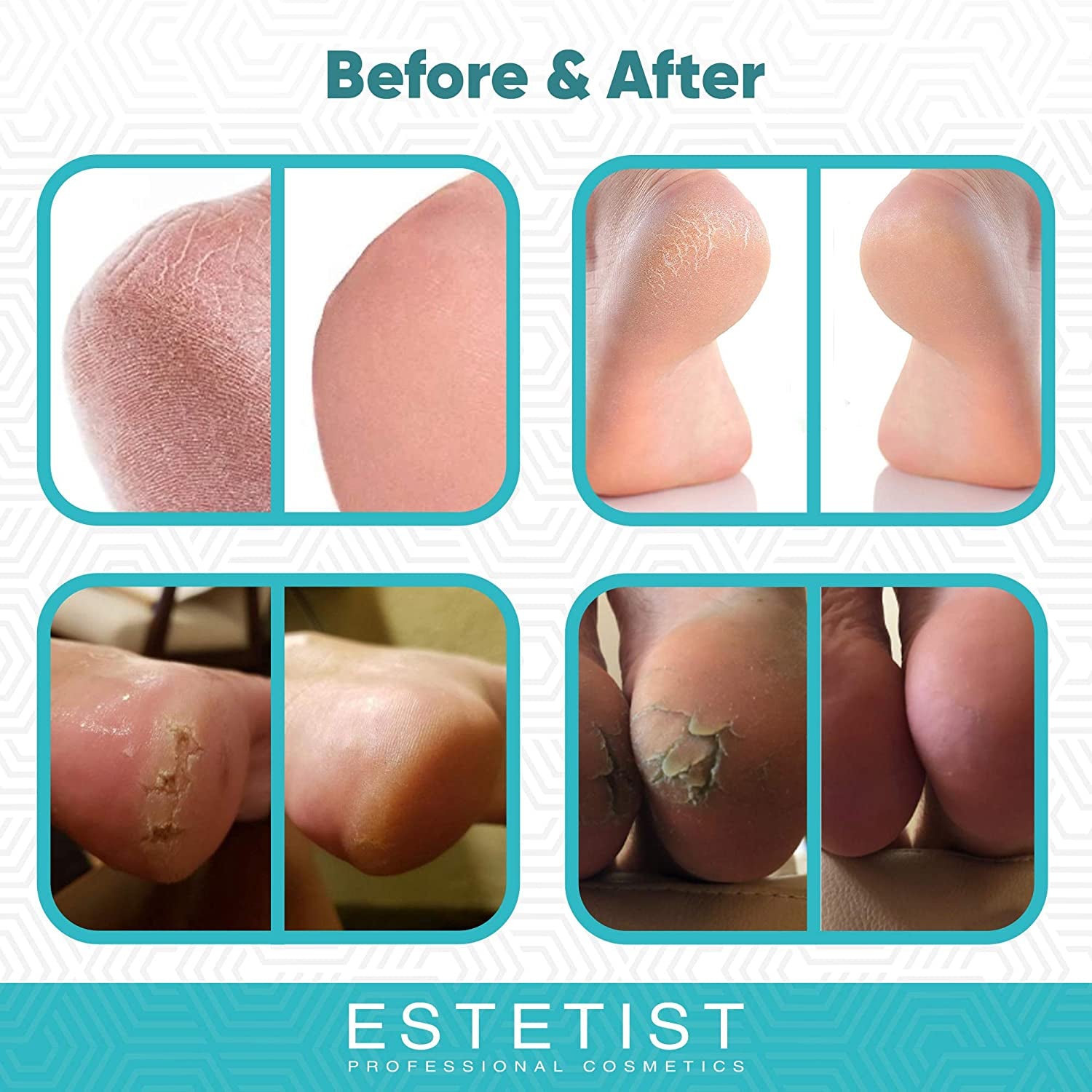 Urea Foot Cream 40%, Foot Lotion for Dry Cracked Feet, Moisturizer for Rough Heel, Foot Care Lotion with Vitamin E and Aloe Vera, Reduce Itching Health & Beauty > Personal Care > Foot Care ESTETIST COSMETICS   
