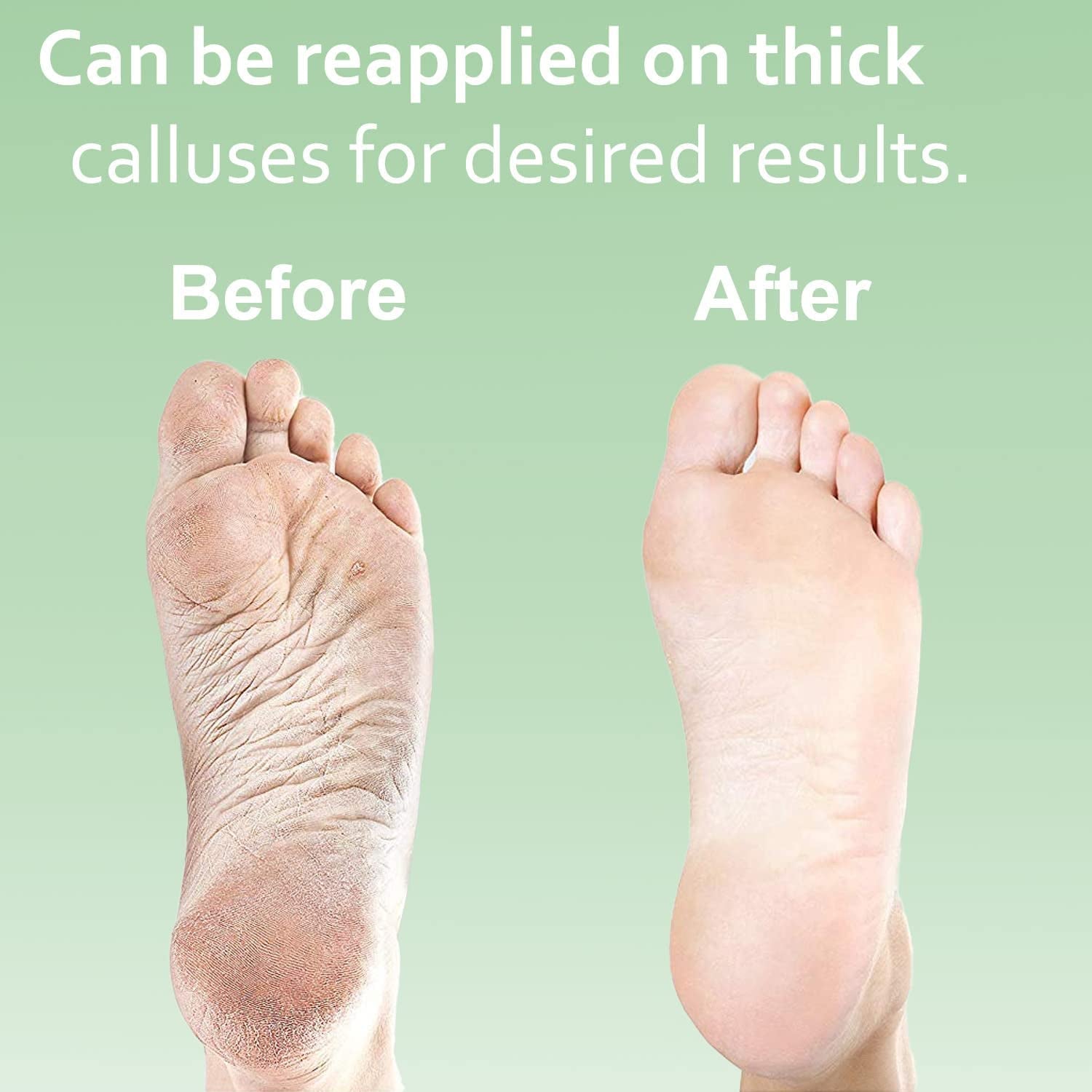 Dr. Entre'S Callus Remover Kit for Feet: 8Oz Callus Remover Gel, Foot File, Pumice Stone, 5 Glove Pairs for Gel Application, Spa Kit, Foot Care, Pedicure Tools, Scrubber Health & Beauty > Personal Care > Foot Care EntreFeet   