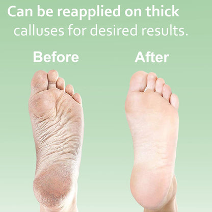 Dr. Entre'S Callus Remover Kit for Feet: 8Oz Callus Remover Gel, Foot File, Pumice Stone, 5 Glove Pairs for Gel Application, Spa Kit, Foot Care, Pedicure Tools, Scrubber Health & Beauty > Personal Care > Foot Care EntreFeet   