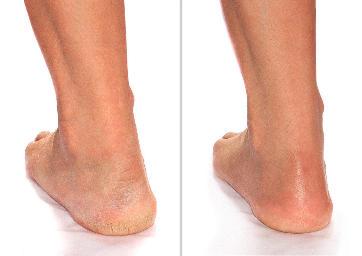 Advanced Clinicals Cracked Heel Foot Cream Moisturizer Lotion W/ Shea Butter, Skin Care Moisturizing Cream Helps Heal Dry Cracked Heels, Rough Spots, Calluses, & Dry Skin on Feet, Large 8 Fl Oz Health & Beauty > Personal Care > Foot Care Advanced Clinicals   