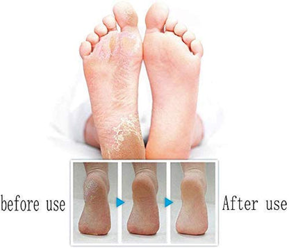 Foot Care Pedicure Callus Shaver Hard Skin Remover,Hand Callus Remover,Foot Callus Shaver Heel Hard Skin Remover for Hand Feet with Stainless Steel Handle(24Pieces) Health & Beauty > Personal Care > Foot Care Klemon   