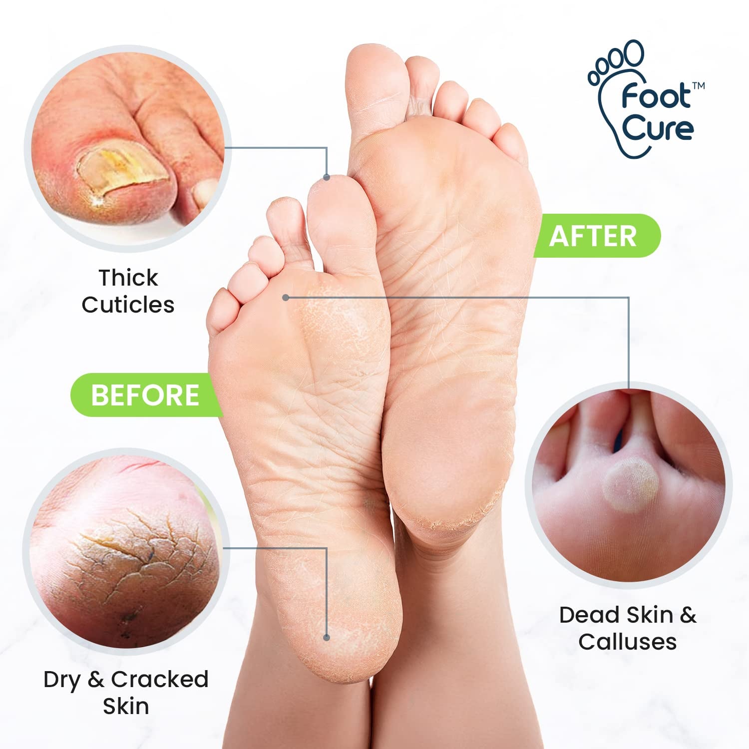 Tea Tree Foot Soak & Callus Remover Gel Kit - Extra Strength Callus Remover Gel & Antifungal Foot Soak with Epsom Salts for Calluses, Dry Cracked Heels, Toenail Fungus & Odor - Pedicure for Tired Feet Health & Beauty > Personal Care > Foot Care FOOT CURE   