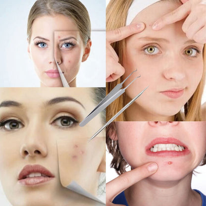 FIXBODY Blackhead and Splinter Remover Tools - Stainless Steel Professional Easily Cure Pimples Whiteheads Comedones Acne Zit Ingrown Hairs and Facial Impurities Bend Head Tweezer Surgical Kit Health & Beauty > Personal Care > Cosmetics > Cosmetic Tools > Skin Care Tools FIXBODY   