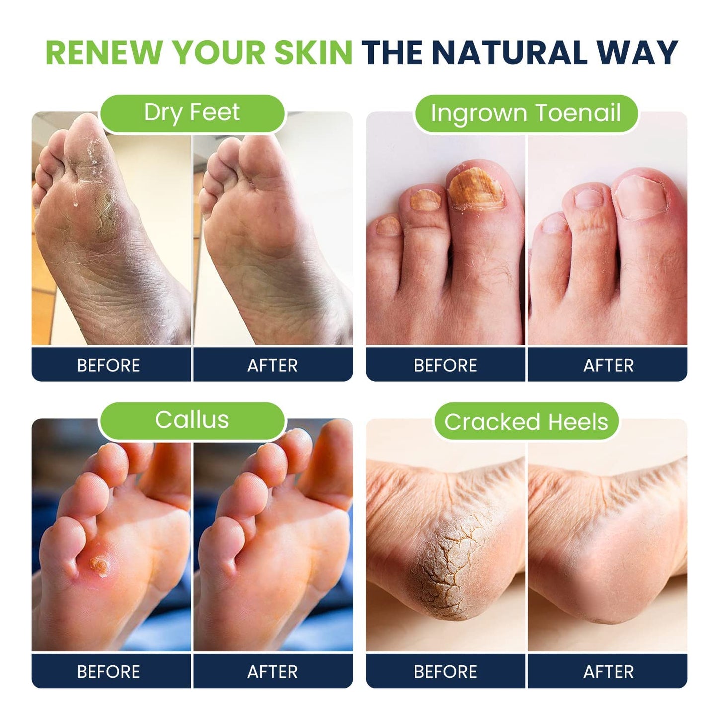 Tea Tree Oil Foot Soak with Epsom Salt - for Toenail Repair, Athletes Foot & Softens Calluses - Soothes Sore & Tired Feet, Nail Discoloration, Foot Odor Scent, Spa Pedicure, Foot Care - Made in USA, 16 Oz Health & Beauty > Personal Care > Foot Care FOOT CURE   