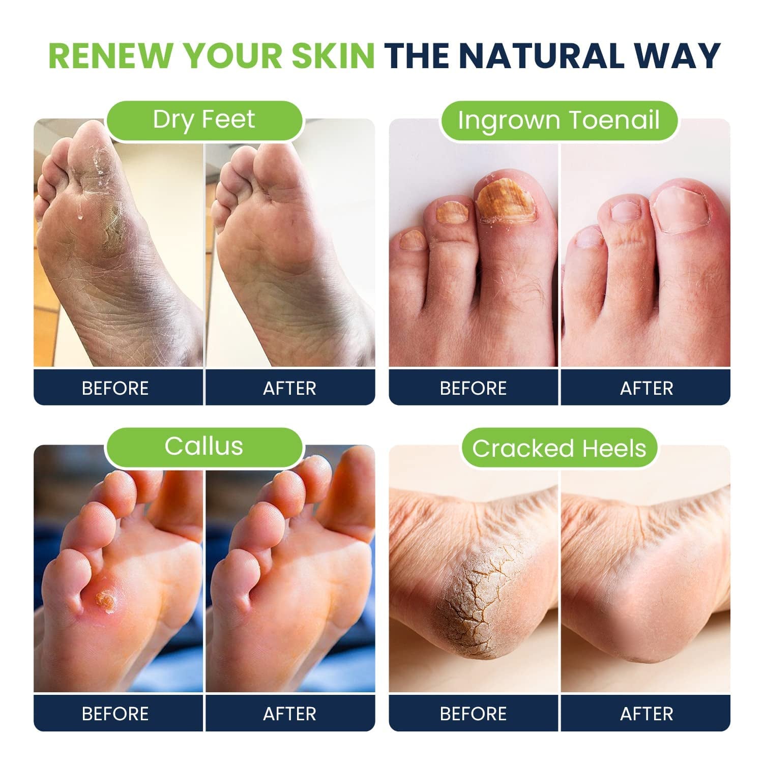 Tea Tree Oil Foot Soak with Epsom Salt - for Toenail Repair, Athletes Foot & Softens Calluses - Soothes Sore & Tired Feet, Nail Discoloration, Foot Odor Scent, Spa Pedicure, Foot Care - Made in USA, 16 Oz Health & Beauty > Personal Care > Foot Care FOOT CURE   