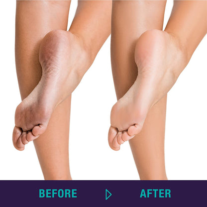 TRIM Simply Foot 4-In-1 Foot Paddle – Include Metal Foot Rasp, Pumice Stone, Foot Brush, and Abrasive Surface – Easy to Use Foot Care Tools for DIY Pedicures – Ideal for Men and Women – Teal Health & Beauty > Personal Care > Foot Care Trim   